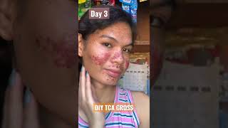 DAY 3  DIY TCA CROSS  Skin Update  Acne Scars Treatment [upl. by Eiryk259]