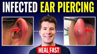 Doctor explains HOW TO RECOGNIZE AND TREAT INFECTED EAR PIERCING [upl. by Jessen635]