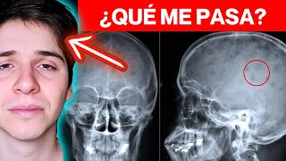 MIELOMA MÚLTIPLE ► FISIOPATOLOGÍA y SÍNTOMAS  EXPLICACIÓN MAESTRA en 8 MINUTOS MÍRALO 😲😲😲😲😲😲😲 [upl. by Rehttam389]