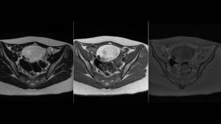 CASO Teratoma ovariano [upl. by Higginbotham]