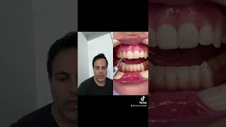 cosmetic tooth contouring and reshapingdentist Tooth Makeover [upl. by Eiramana]