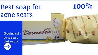 dermadew lite soap review and uses in tamil  for acne scars and dark spots dermadew [upl. by Karlow]