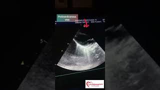 Perimembranous VSD  VSD  congenital heart anomalies  VSD Echo [upl. by Aerol]