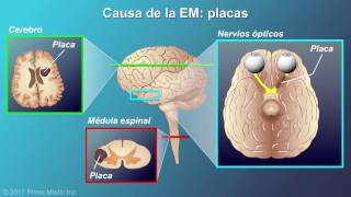 Explicación de la esclerosis múltiple [upl. by Kopp]