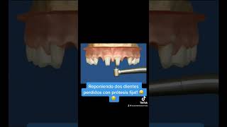 Reponiendo dos dientes perdidos con prótesis fija 😃😌 shorts [upl. by Faria598]