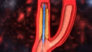 Internal Carotid System Dr Adel Bondok [upl. by Som916]