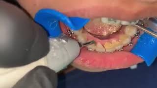 How to Remove Tartar amp Plaque from Teeth [upl. by Aserehs]