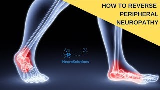 Peripheral Neuropathy Treatment Leg amp Foot Nerve Pain HOME REMEDIES [upl. by Drawyeh]