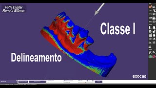 PPR DIGITAL EXOCAD  DELINEAMENTO CLASSE I INFERIOR  PARTIALCAD EXOCAD [upl. by Gagliano89]