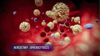 How Hereditary Spherocytosis Causes Anemia [upl. by Festus]