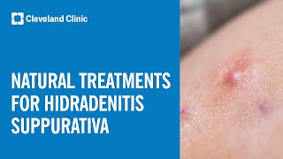 Natural Treatment Options for Hidradenitis Suppurativa [upl. by Sivet]