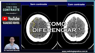 Como saber se a tomografia de crânio foi feita com ou sem contraste venoso [upl. by Ojiram]