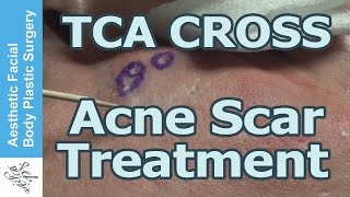 Acne Scar Removal in Los Angeles using TCA Cross Technique [upl. by Baseler]