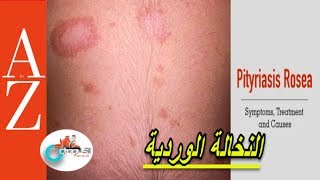 Pityriasis Rosea From A to Z  النخالة الوردية  اعراضها واسبابها  تطور المرض  كل اربعاء [upl. by Acnaib]