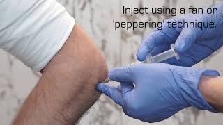 Injection Technique for Lateral Epicondylalgia [upl. by Iaka711]