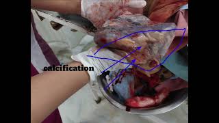 calcification of plecenta  midwifery nursingofficer mbbs education [upl. by Rubio]