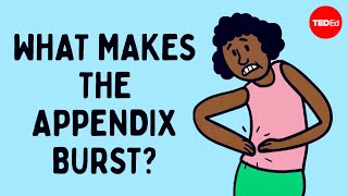 What does appendix pain feel like  David R Flum [upl. by Quinby12]