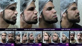 Microagulhamento antes e depois contra cicatriz de acne [upl. by Oemac]