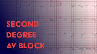 Second Degree Heart Block  Electrocardiogram ECGEKG Interpretation [upl. by Nade]