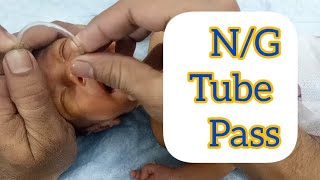 Nasogastric NG Tube insertion in neonateNewborn  How to place a nesogastric  NG feeding tube [upl. by Chute]