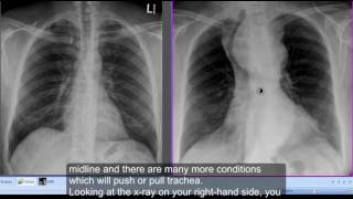 Chest xray Retrosternal Goitre [upl. by Nylorahs678]