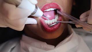 How teeth cleaning is done   DENTAL SCALING  FMS DENTAL HOSPITALS [upl. by Ajin]