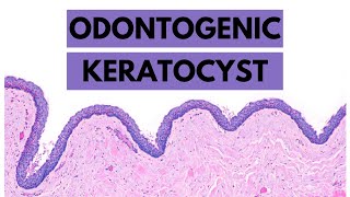 Odontogenic Keratocyst Clinical features Radiology Histology and Treatment [upl. by Hembree]