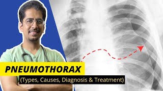 PNEUMOTHORAX Types Causes Diagnosis amp Treatment  Detailed video [upl. by Lamak]