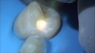 Video Case Study Class II Procedure Using the Solea Dental Laser [upl. by Adriena]