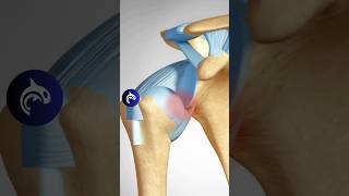 Shoulder Dislocation Reduction [upl. by Alyled]