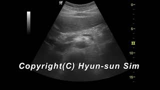 papillary process caudate lobe Ultrasonography미상엽 유두상 돌기 [upl. by Norramic]