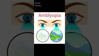 Amblyopia  Common Eye Diseases  eyes amblyopia eyedisease eyediseases shorts opthalmology [upl. by Danete]