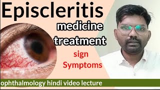 Episcleritis treatment  Episcleritis disease in eye  sclera anatomy  Episcleritis  optometry [upl. by Lugo]