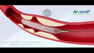 BrosMed Alveo HP CTO Balloon Dilatation Catheter [upl. by Ybeloc812]