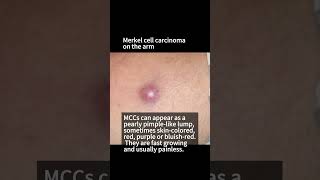 What does Skin Cancer look like Merkel Cell Carcinoma skincare skincancer cancer [upl. by Sidra]