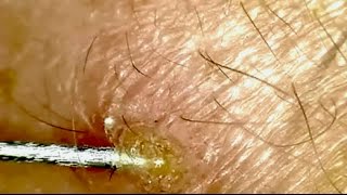 Magnified Pimple Scab Picking [upl. by Neersin]