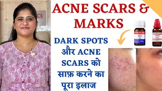 Acne Scars और Pimple Marks का इलाज ॥ Homeopathic medicines to remove Dark spots and Pitting Scars ॥ [upl. by Grove]