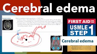 Cerebral edema in HindiUrdu by first aid for USMLE step 1 [upl. by Irtak]