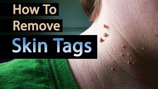 How to Remove Skin Tags  Skin tags – causes symptoms and removal [upl. by Nan]