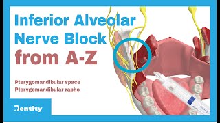 Inferior Alveolar Nerve Block  AZ [upl. by Aerbma]