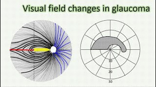 Visual field changes in glaucoma [upl. by Isla233]