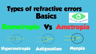 Emmetropia amp Ametropia Different types of refractive errorsMyopia HypermetropiaAstigmatism [upl. by Brunell795]