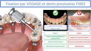 All on 4  Fixation par vissage et dents provisoires fixes [upl. by Nowujalo]