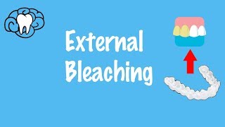 External Bleaching [upl. by Akinahs206]