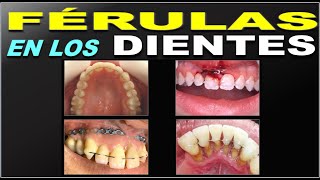 INDICACIONES Y TRATAMIENTOS CON FERULAS DENTALES FERULIZACION [upl. by Ardnot]