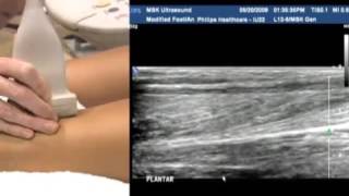 Ultrasound of the Foot and Ankle [upl. by Hellman]