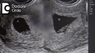 Causes of 3 weeks lag in fetal growth with no heartbeat in 9 week of gestation  Dr Sangeeta Gomes [upl. by Edas]