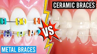 Clear Braces Vs Metal Braces What Type Works Best [upl. by Ydnem]