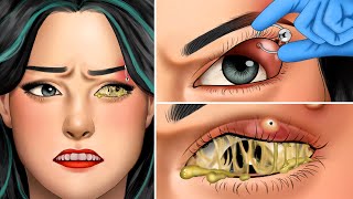 ASMR Remove unmanaged eyebrow piercing pus animation  Squeeze eyes acne [upl. by Sneed963]