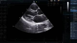 Transthoracic Echocardiography TTE  A Standard Examination [upl. by Blase]